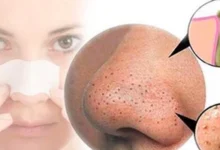 علاج البثور السوداء