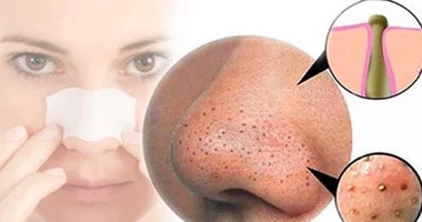 علاج البثور السوداء.. 7 وصفات طبيعية تخلصك من الرؤوس السوداء نهائياً في 2026 8 علاج البثور السوداء