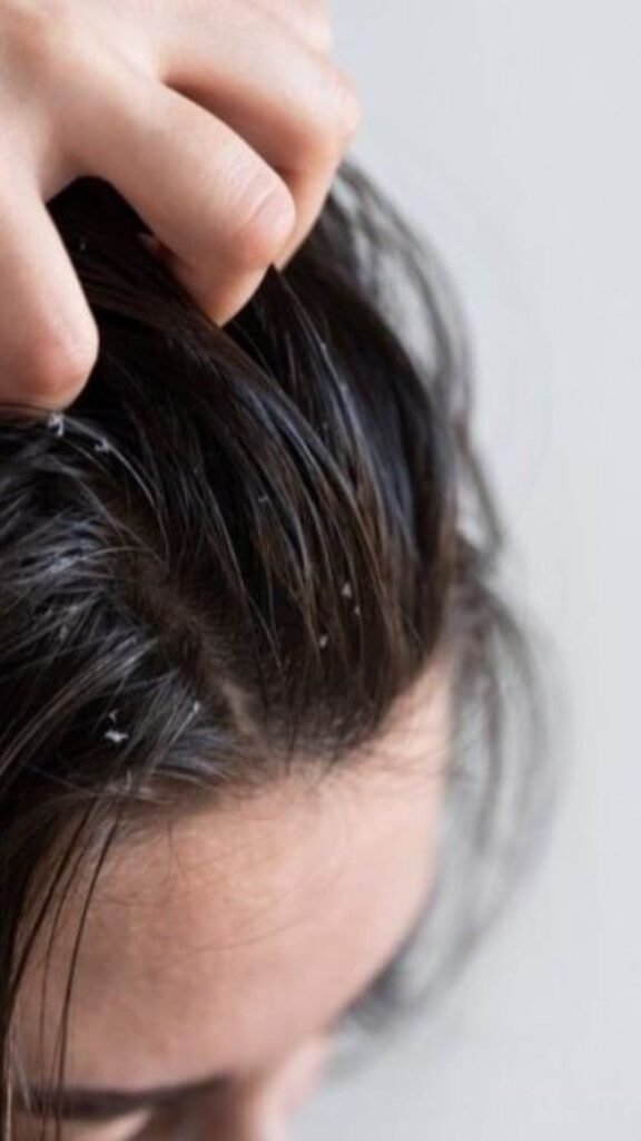 دليلك الشامل لعلاج مشاكل قشرة الشعر نهائياً بأفضل الطرق الطبيعية والطبية 2026 3 9ce9f48ea1aef7b75e1fa896c194305a