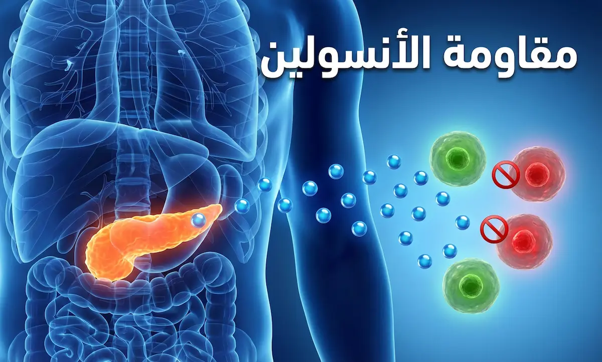 علاج مقاومة الأنسولين
