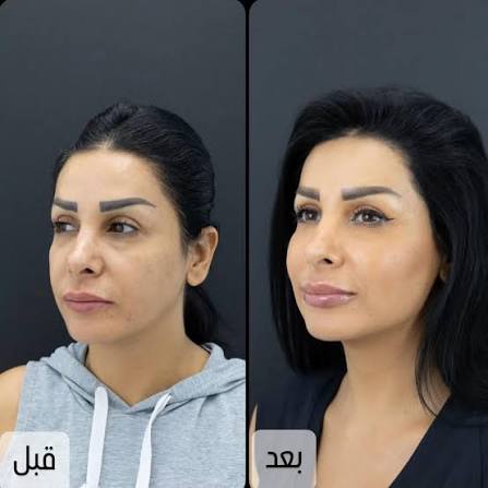 حقن الدهون الذاتية تحت العين