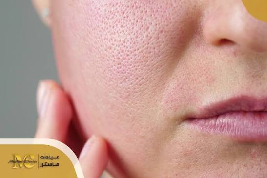 مشاكل البشرة الدهنية