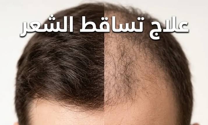 تساقط الشعر